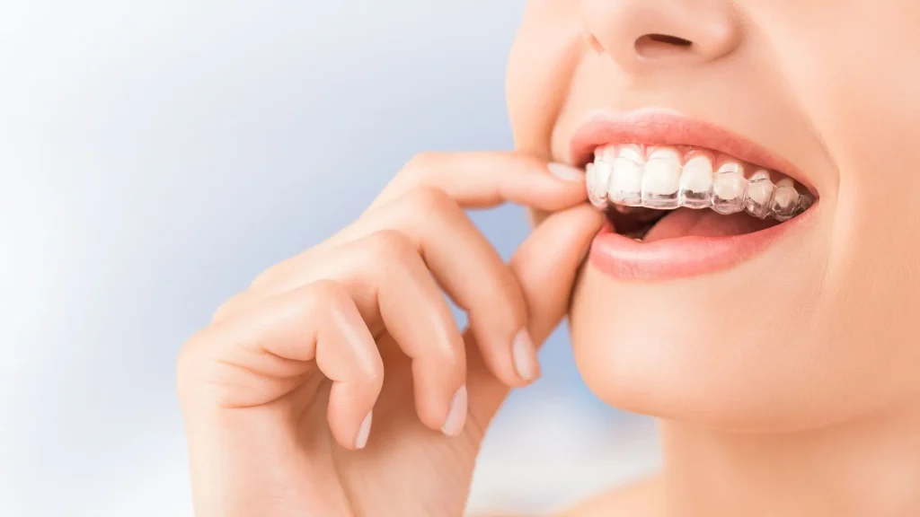 Apparecchio di contenzione ortodontica
